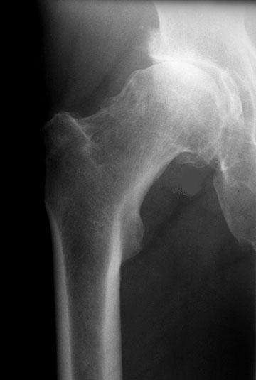 Radiografia de una cadera con artrosis
