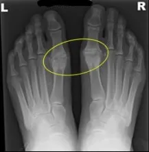 Radiografías de hallux rigidus