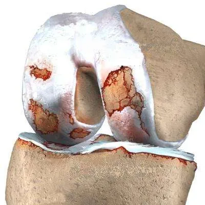 Artrosis de rodilla con deterioro del cartílago articular