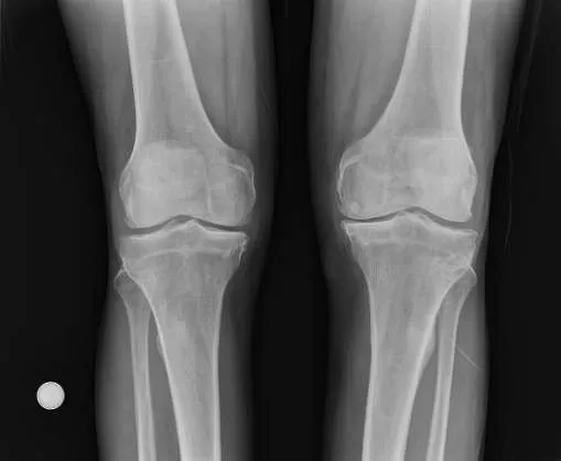 Radiografía de una rodilla con artrosis