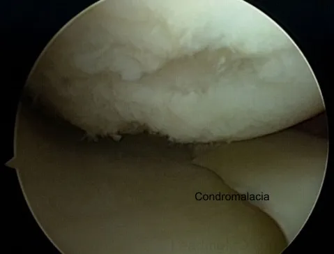 Lesiones condrales y osteocondrales de rodilla