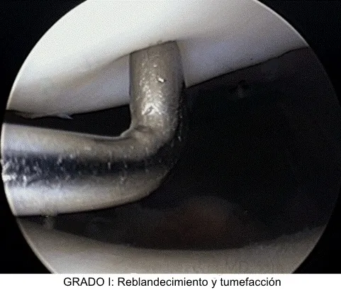 Lesión condral inicial de rodilla