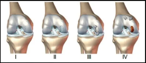 Lesión osteocondral de rodilla