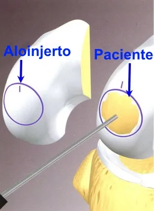 Aloinjerto osteocondral de rodilla