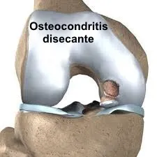 Osteocondritis disecante de la rodilla