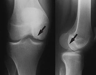 Radiografía de osteocondritis disecante de la rodilla