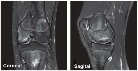 Resonancia magnética de osteocondritis disecante de rodilla