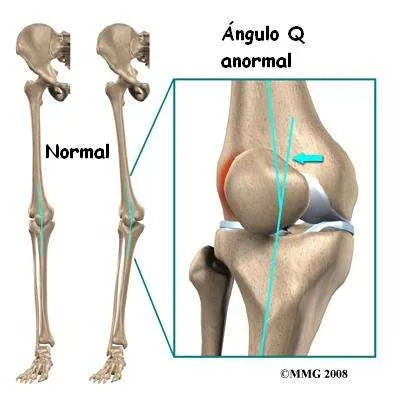 Ángulo Q de la rodilla