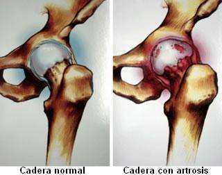 Articulación de la cadera afectada por artrosis