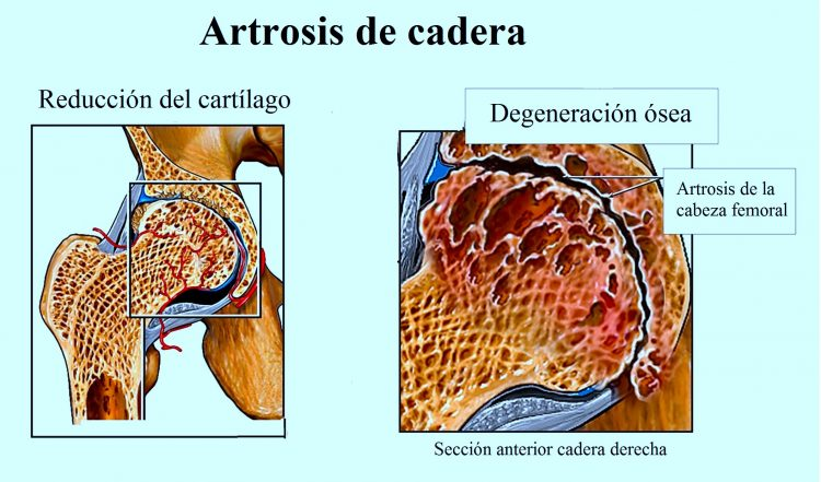 Patologías frecuentes de la cadera