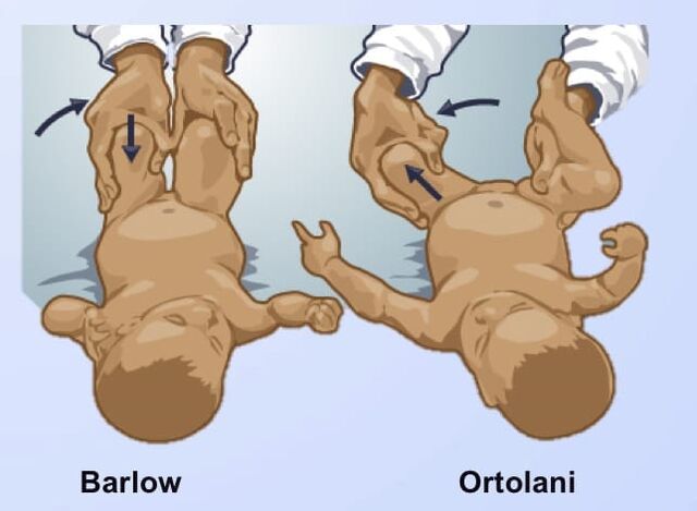 Pruebas en la luxación congénita de cadera