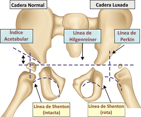 Radiografía de displasia de cadera