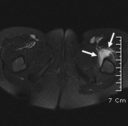 RM con alteración de señal en médula ósea.