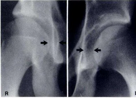 Comparación entre cadera sana y afectada mediante distancia teardrop
