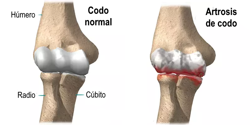 Imagen de artrosis de codo