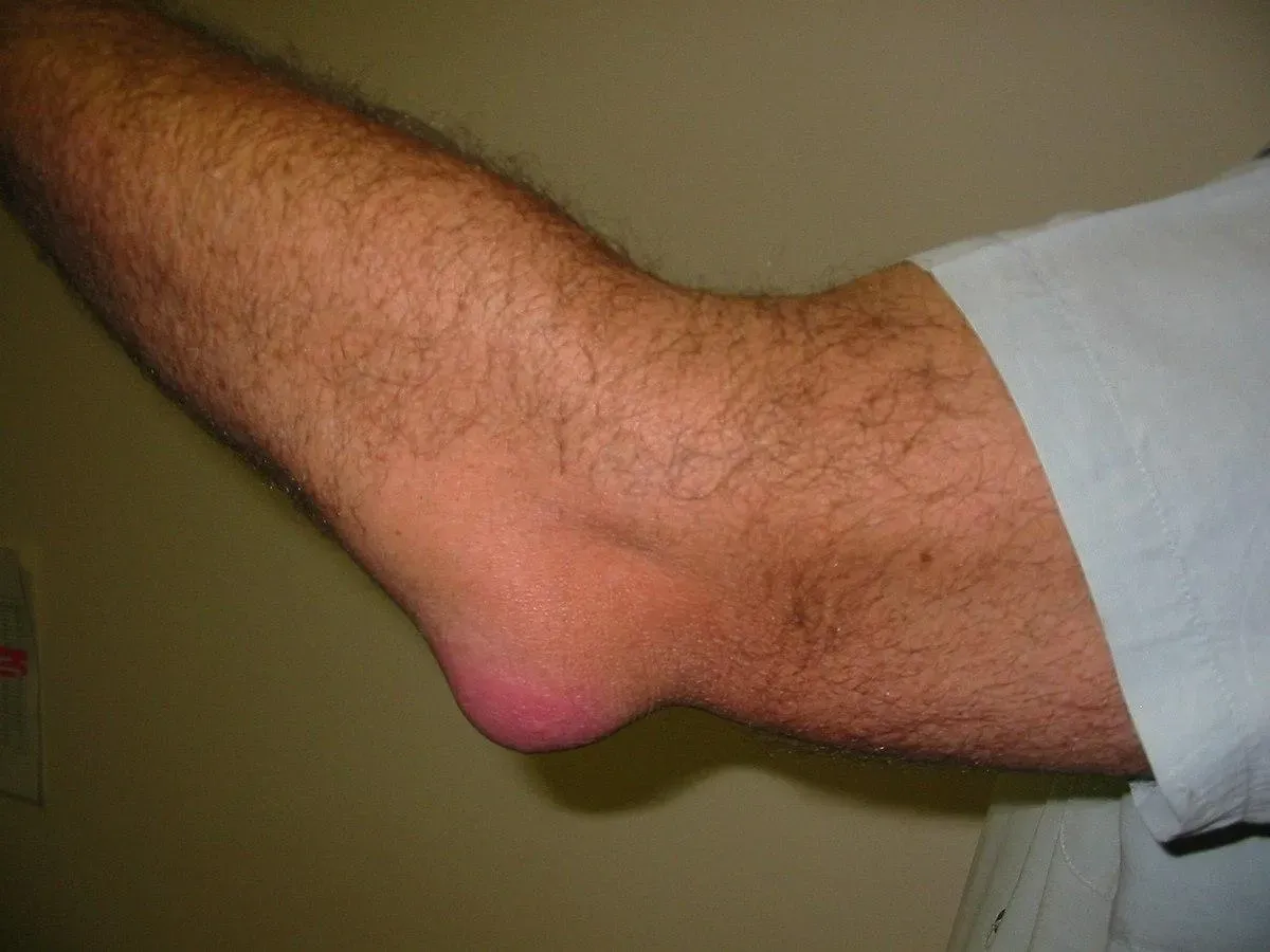Bursitis olecraniana en la parte posterior del codo