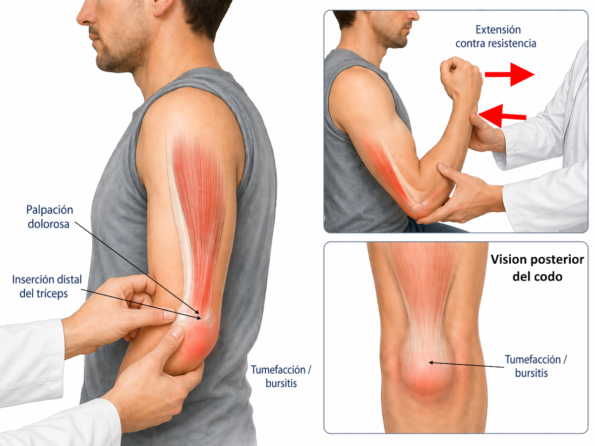 Exploración clínica de la tendinitis tricipital con palpación distal del tríceps y extensión contra resistencia