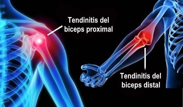 Imagen de tendinitis bicipital