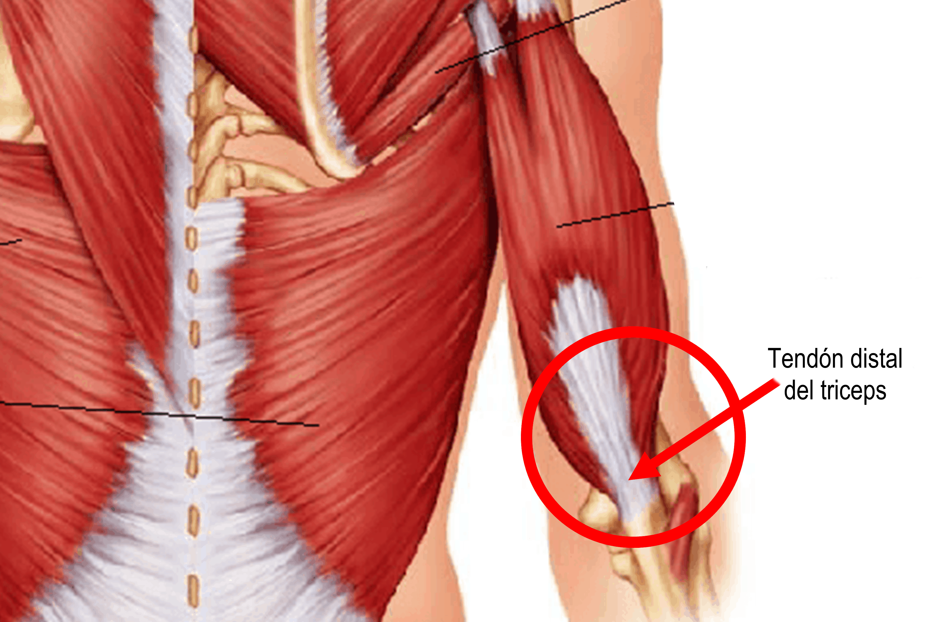 Imagen de tendinitis tricipital