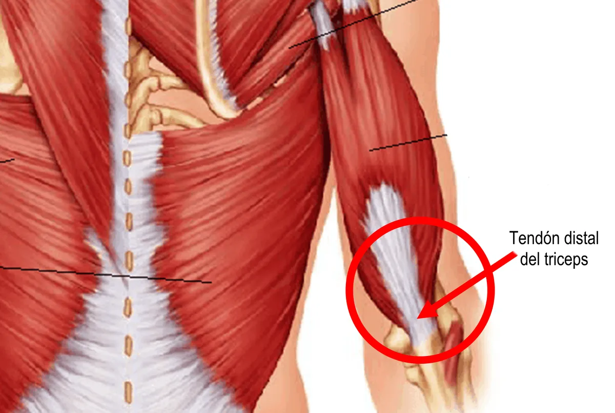Ilustración anatómica de la tendinitis tricipital