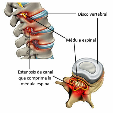 Estenosis lumbar