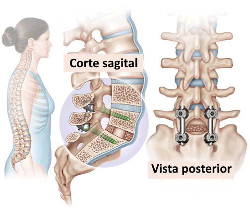Ilustración de artrodesis posterolateral percutánea