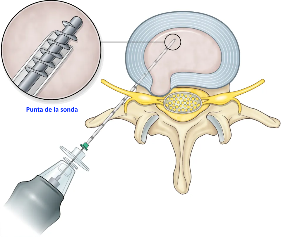 Ilustración de discectomía percutánea mecánica