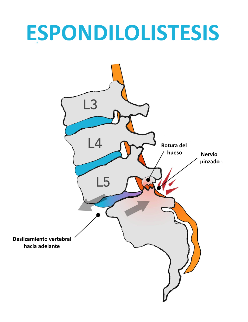 Esquema de espondilolistesis