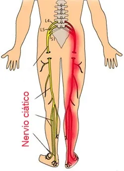 Dolor ciático irradiado por la pierna