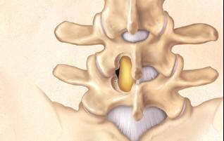 Representación de hernia discal lumbar