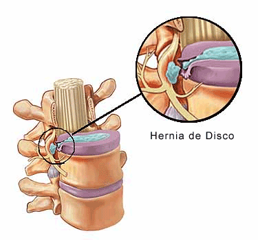 Hernia discal completa