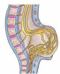Esquema de mielomeningocele