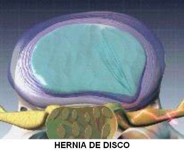 Hernia de disco