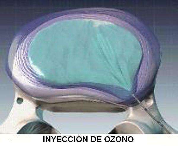 Inyección de ozono
