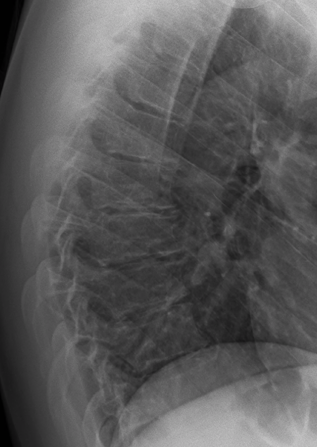 Radiografía lateral de enfermedad de Scheuermann con acuñamiento vertebral torácico