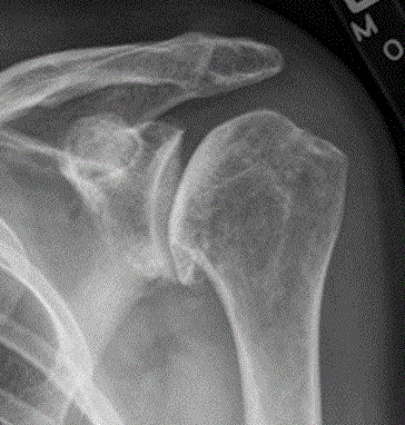 Radiografía de hombro con artrosis glenohumeral