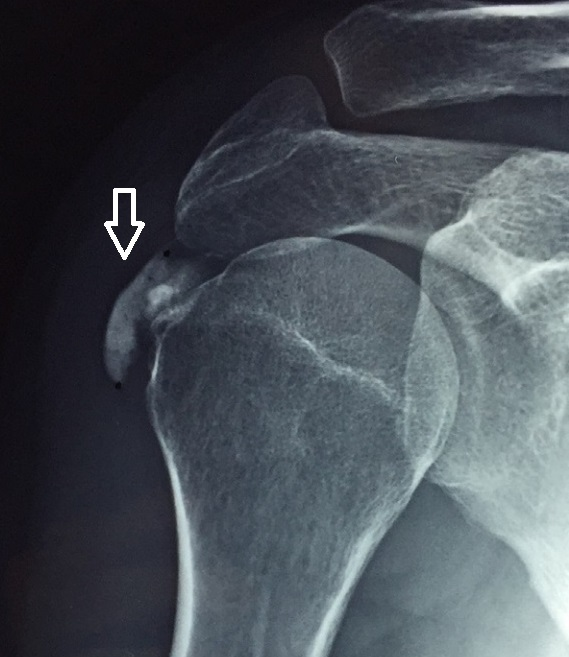 Radiografía con tendinitis calcificante del supraespinoso