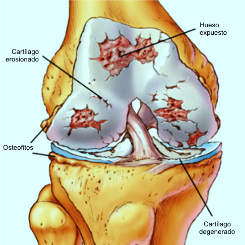 Radiografía de artrosis