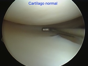 Cartílago articular