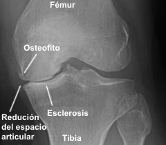 Osteofitos en artrosis