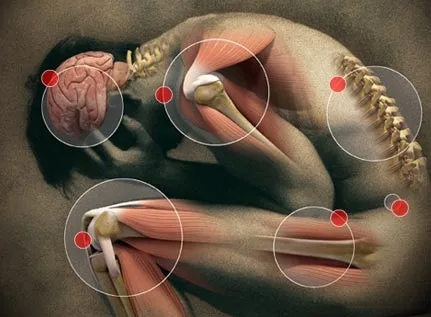 Distribución corporal de los puntos dolorosos en la fibromialgia