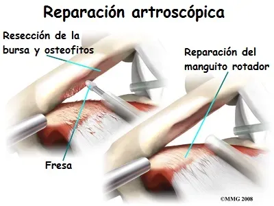 Artroscopia en evaluación