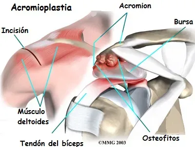 Acromioplastia del hombro paso 3