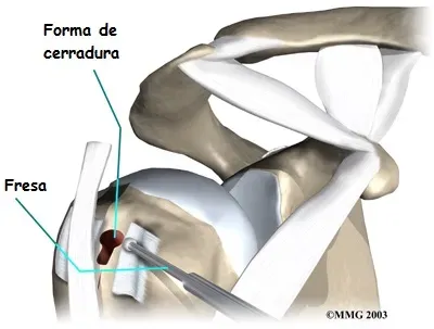 Tenodesis del bíceps