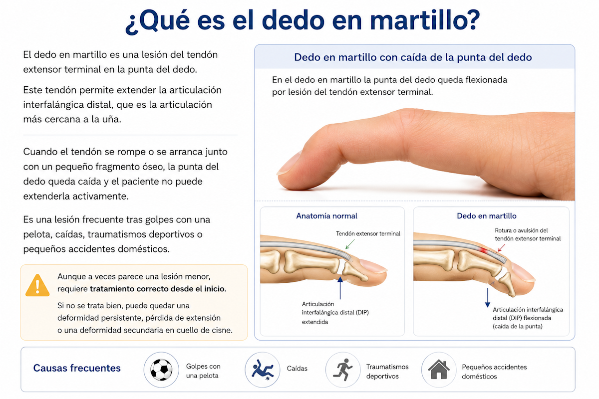 Dedo en martillo con caída de la punta del dedo