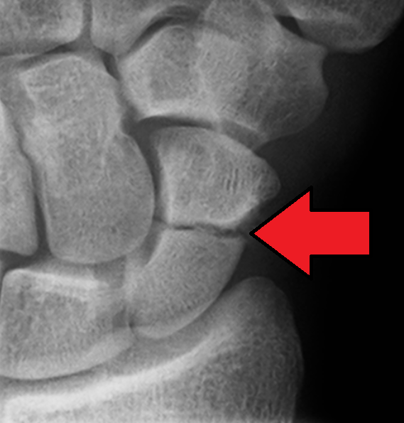 Radiografía de fractura de escafoides carpiano