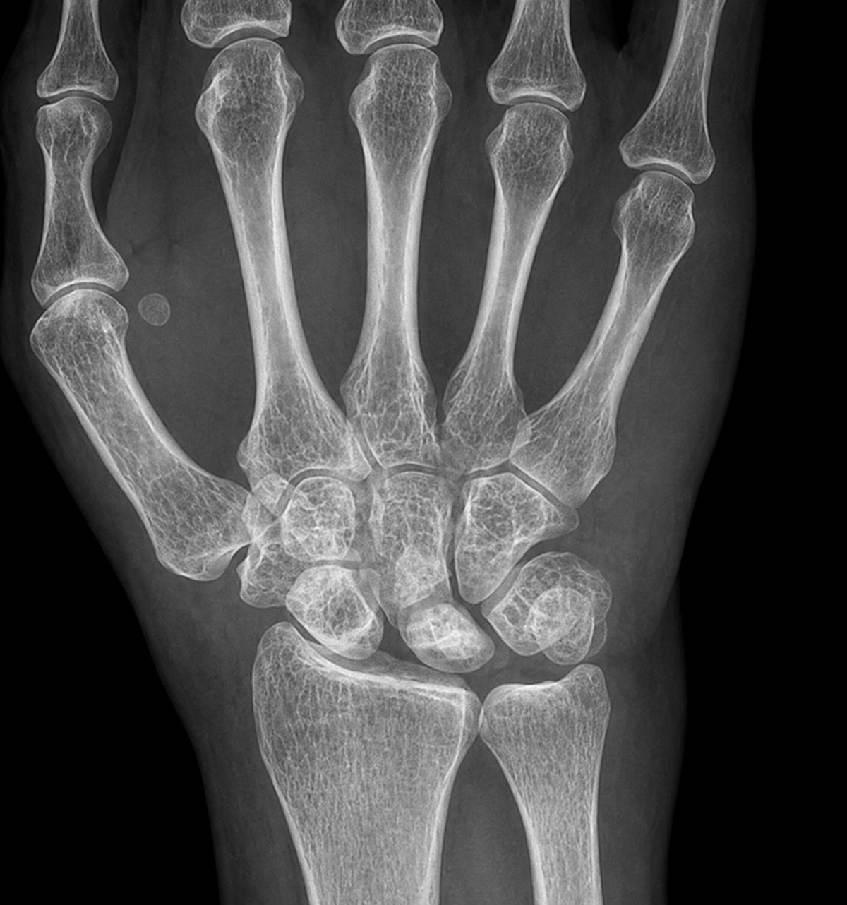Radiografía de inestabilidad escafolunar