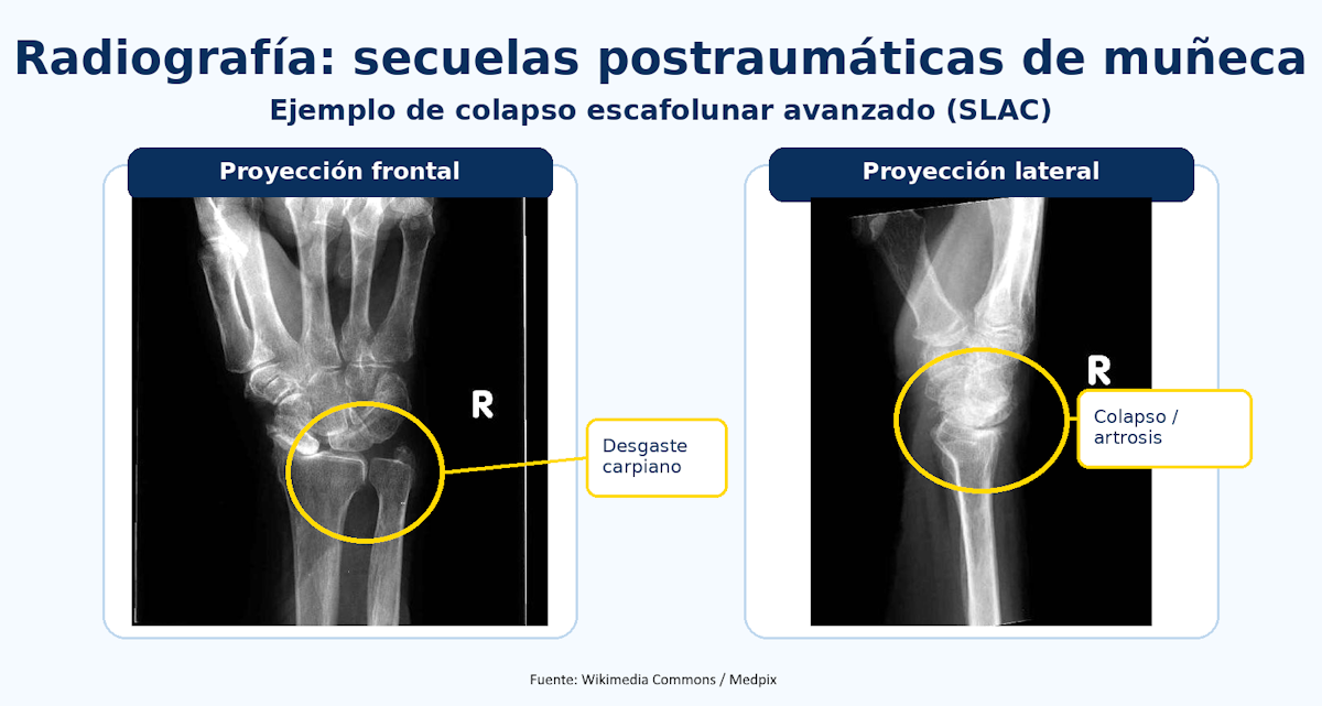 Radiografía de secuelas postraumáticas de muñeca