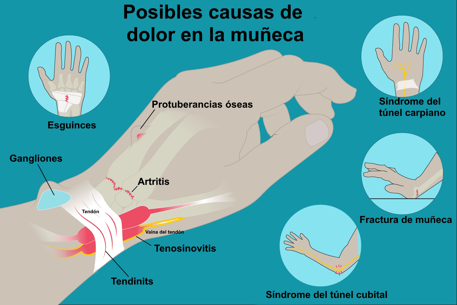 Puntos comunes de dolor en muñeca