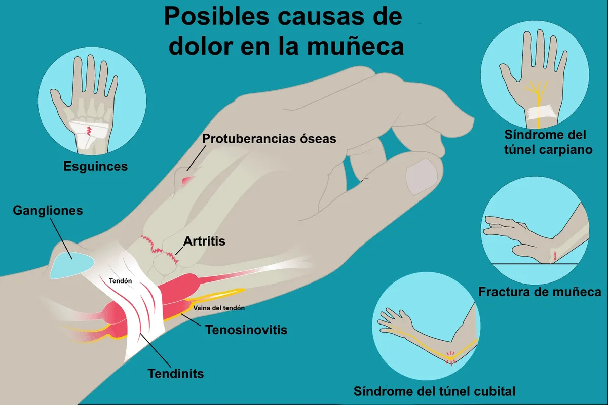 Zonas orientativas de dolor de muñeca y mano